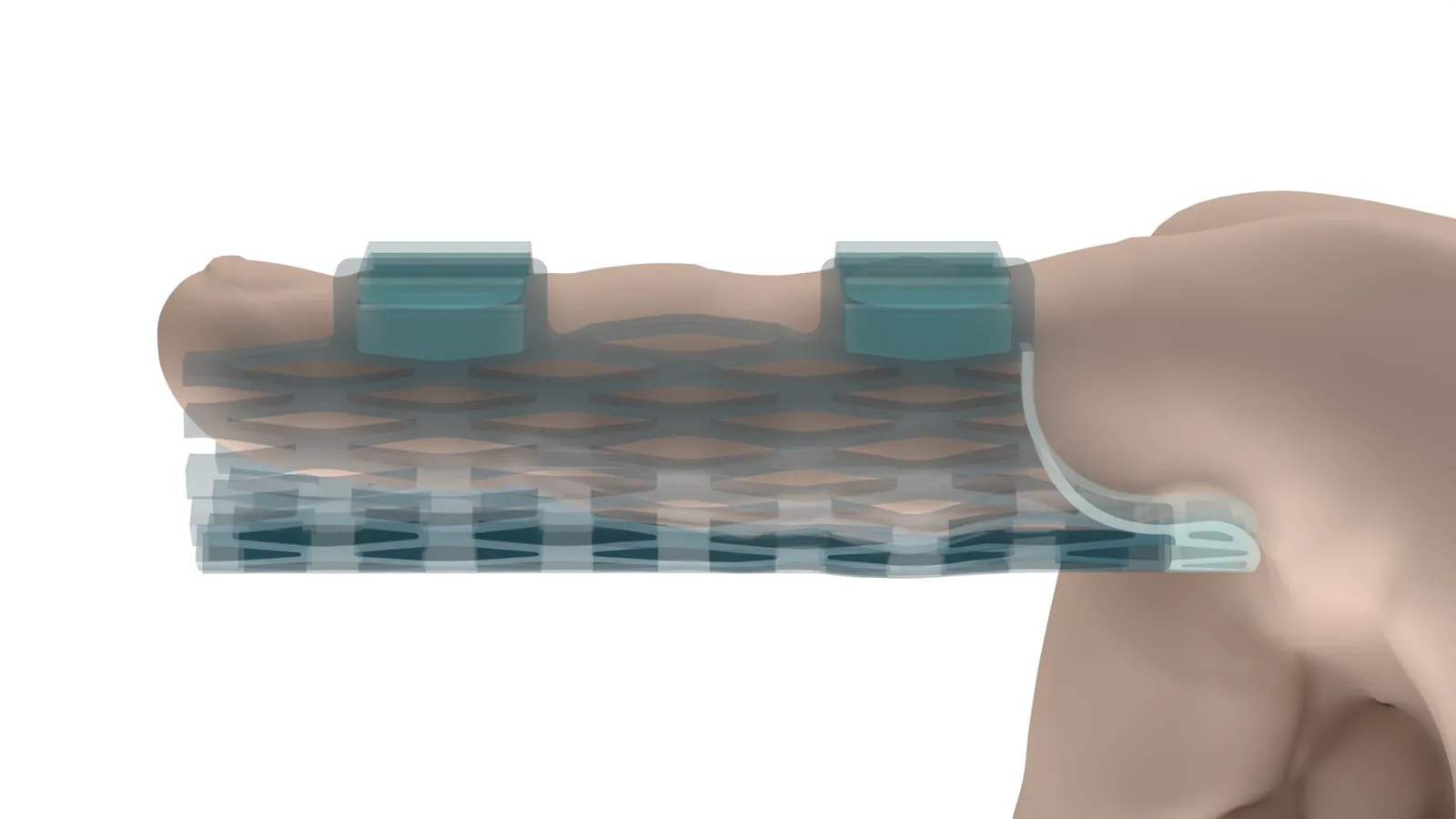 Side x-ray view of a Struxaform part, opened flat